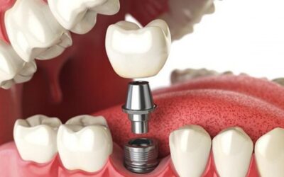 Ano novo, dentes novos: 5 motivos para realizar um implante dental