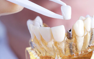 Quais são as vantagens do implante dentário?