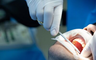 A colocação de implante dentário dói?